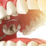 How to Assess Your Tooth Decay Risk
